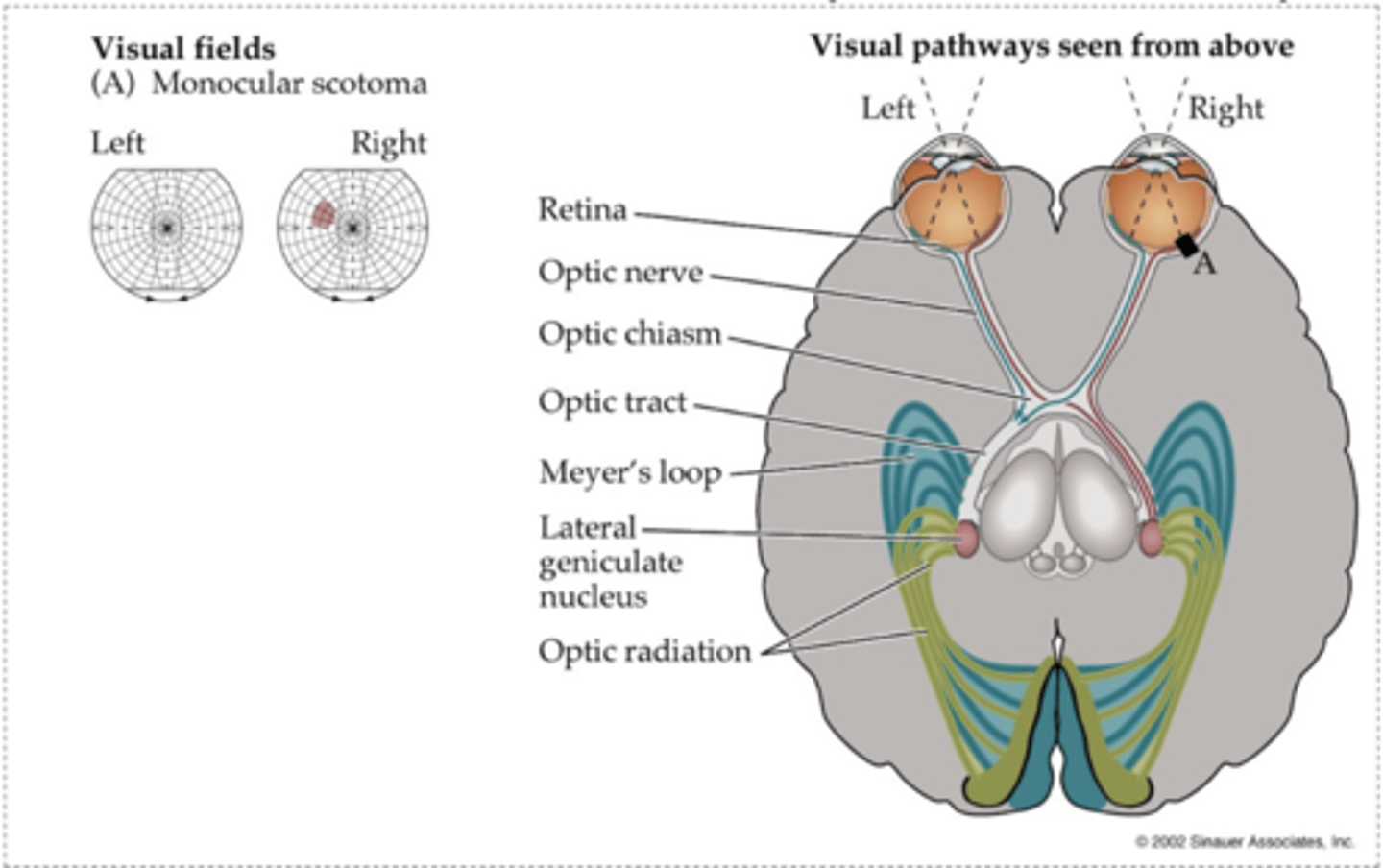 <p>R monocular scotoma (circumscribed region of vision loss)</p>