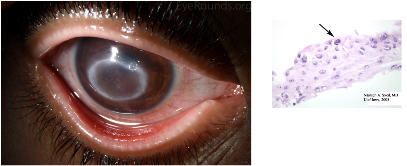 <ul><li><p><strong><u>Caused by Acanthamoeba</u></strong></p></li><li><p><span style="font-size: calc(var(--scale-factor)*21.77px)">Contact lens wearers</span><span><br></span><span style="font-size: calc(var(--scale-factor)*21.77px)">• Using non-sterile tap water to put contact lens in the eye</span><span><br></span><span style="font-size: calc(var(--scale-factor)*21.80px)">• COMMERCIAL contact lens solutions (SCARY!!)</span><span><br></span><span style="font-size: calc(var(--scale-factor)*21.77px)">• Showering while wearing contact lens!</span><span><br></span><span style="font-size: calc(var(--scale-factor)*21.77px)">• Symptoms: Conjunctival hyperemia, tearing, pain, photophobia</span></p></li><li><p><span style="font-size: calc(var(--scale-factor)*21.77px)">Dx: See organisms via staining corneal scrapings with florescent dye calcofluor</span></p></li></ul><p></p>