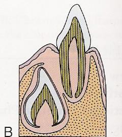 <p>Lingual to the apical third of the primary tooth</p>