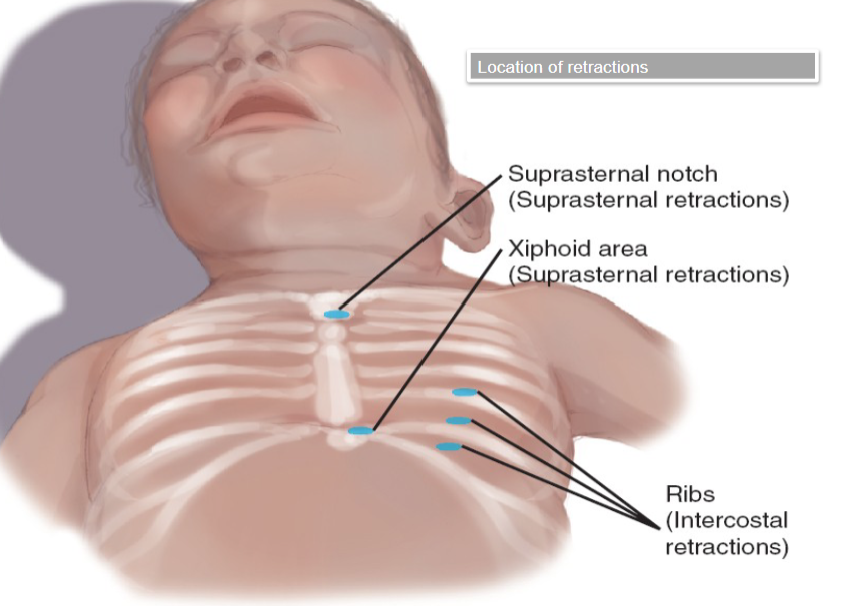 <p>Retraction</p>