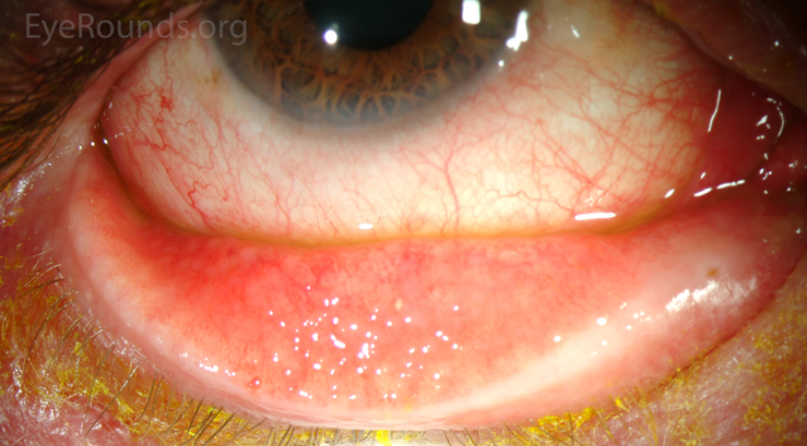follicles in the inferior tarsal conjunctiva