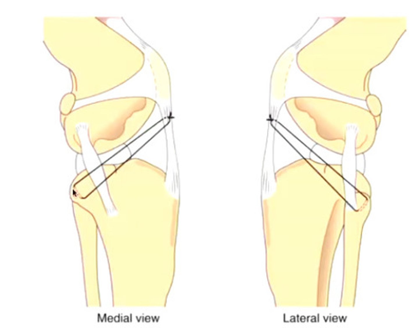 <p>Caudal cruciate ligament ruptures are not frequently seen</p><p>Dx?</p><p>Tx?</p>