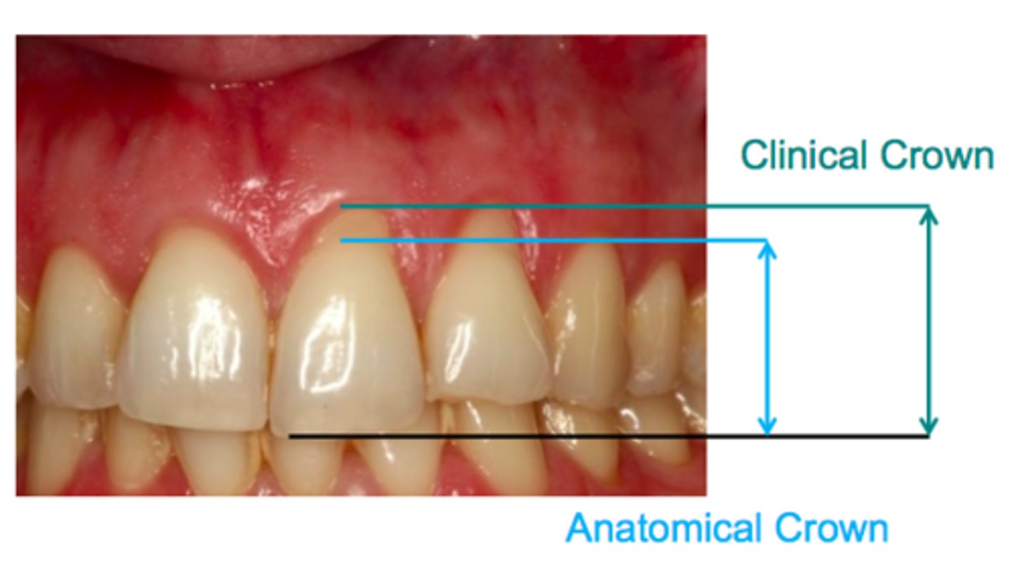 <p>Anatomical crown is that part of the tooth that is covered by Enamel or outer covering of the tooth. Its up to the cemento-enamel junction.</p>