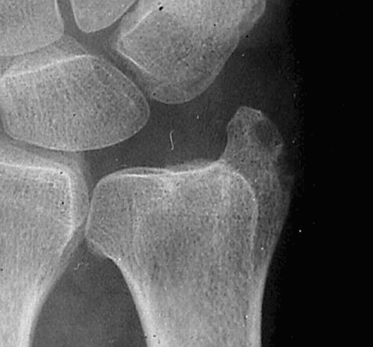 <p>Ulnar styloid process erosions</p>