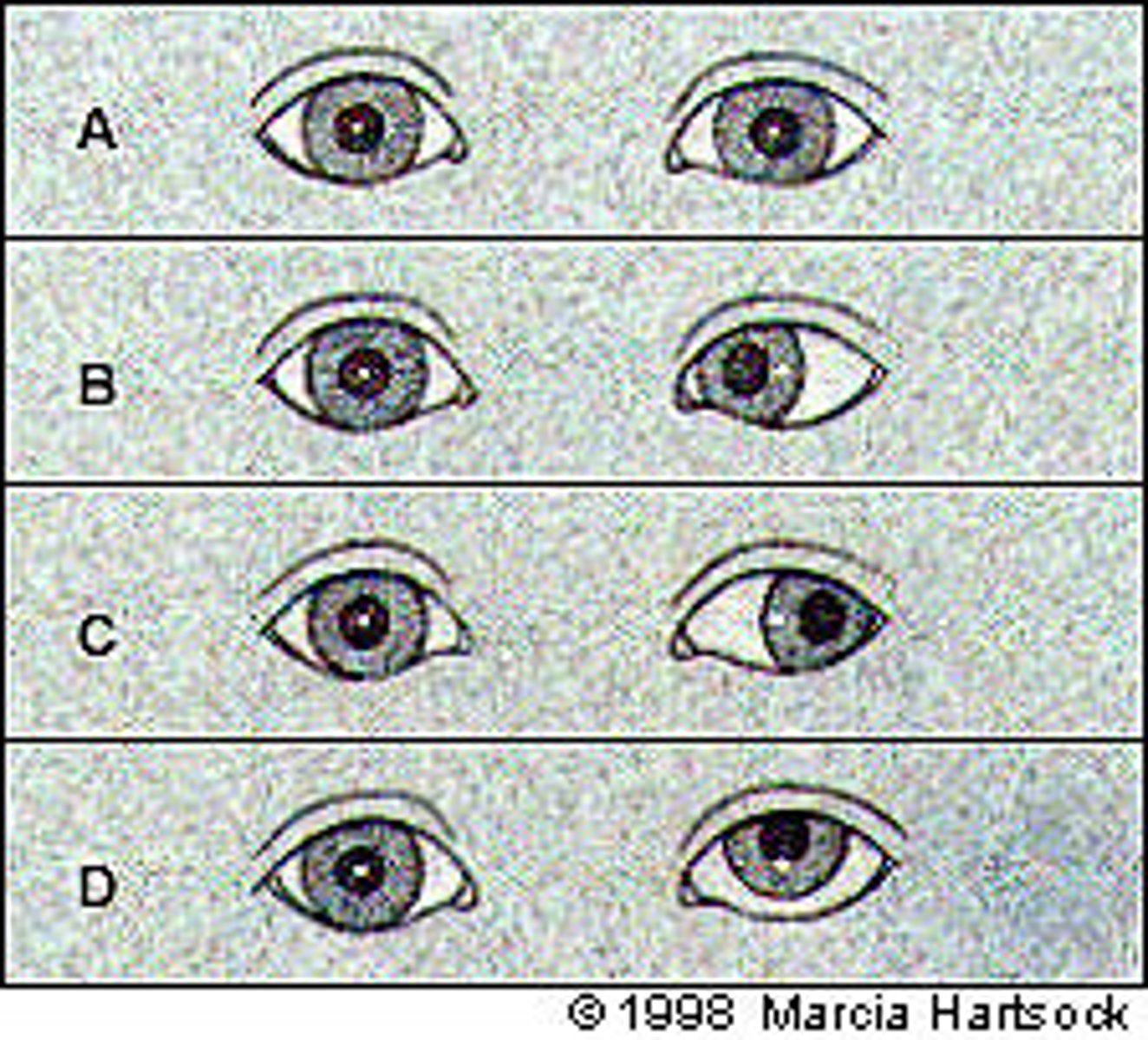 <p>Dysconjugate gaze (gaze doesn't line up b/w the eyes)</p>