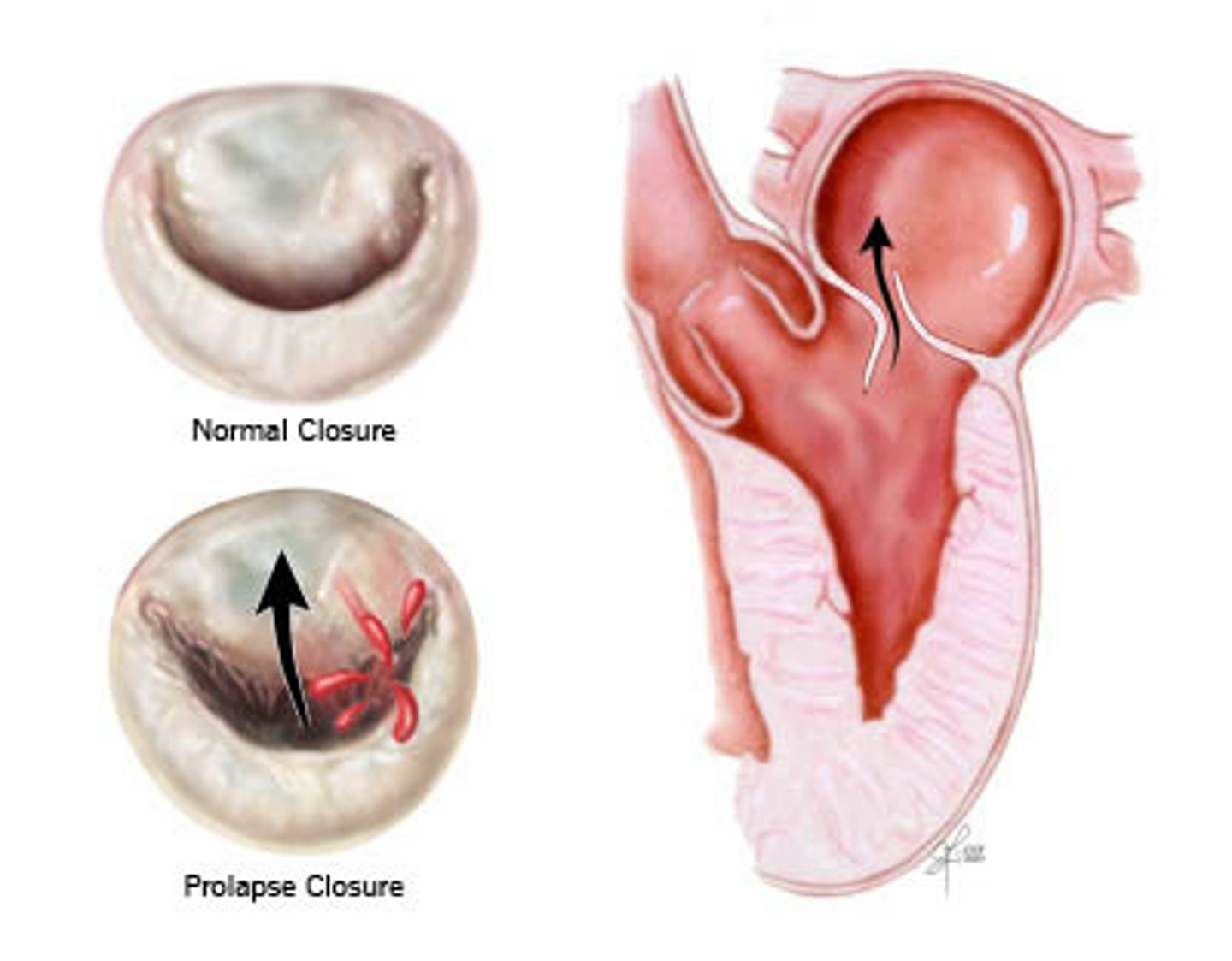 <p>Mitral Valve Prolapse</p><p>- mid systolic click</p><p>- shortness of breath</p><p>- palpitations</p>