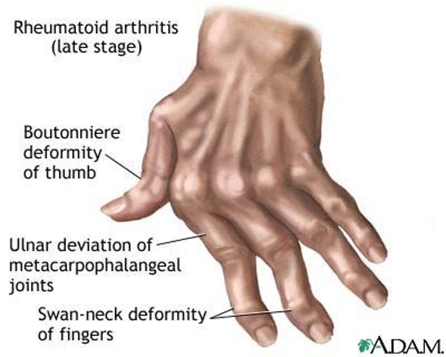 <p>Rheumatoid arthritis</p>