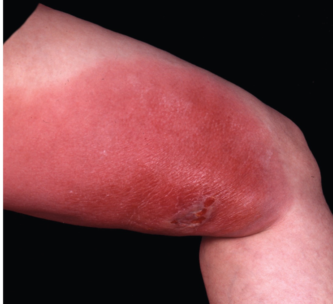 \
What is this called?

A. Cellulitis

B. Impetigo

C. Positive TB test

D. Bullseye lesion