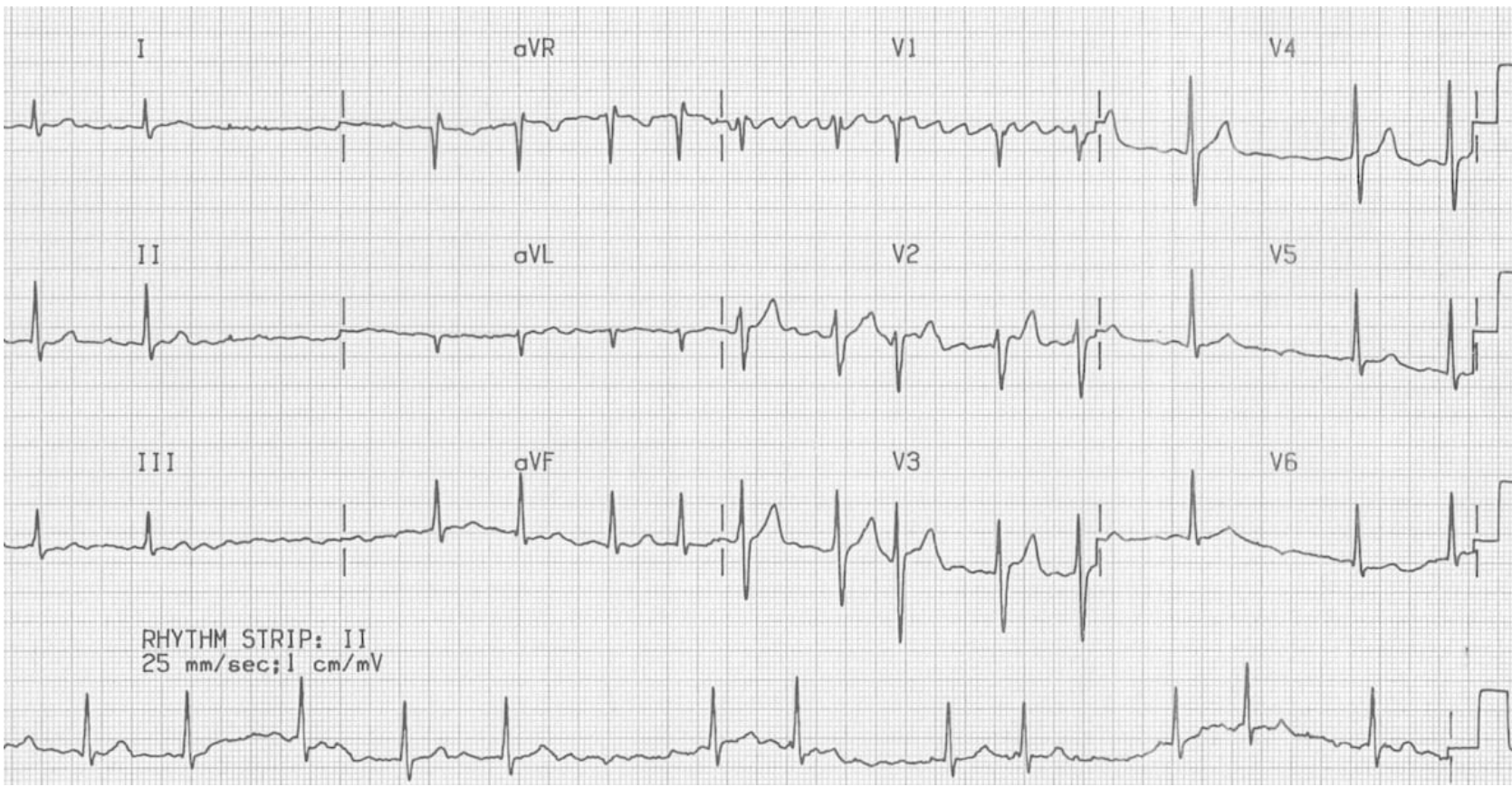 <p>If we are going to cardiovert a STABLE patient in a.fib what must be done first?</p>