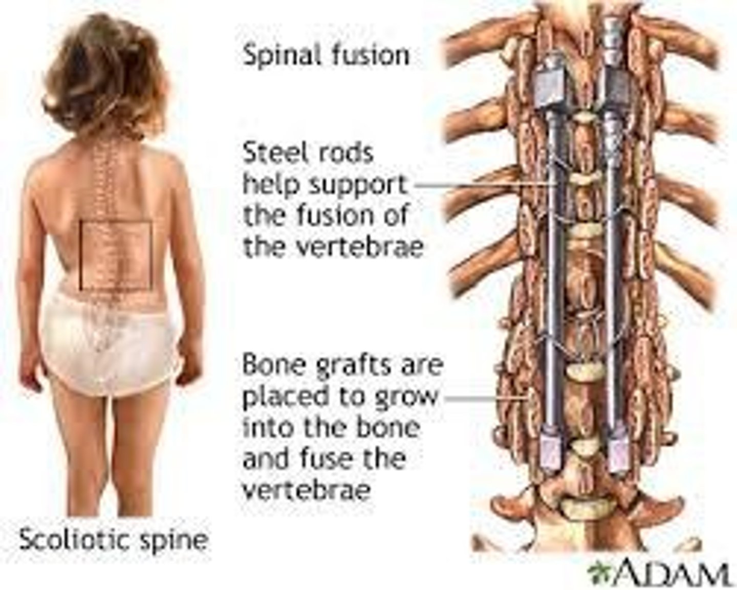 <p>Curvature of 45-50 degrees may need spinal fusion.</p>