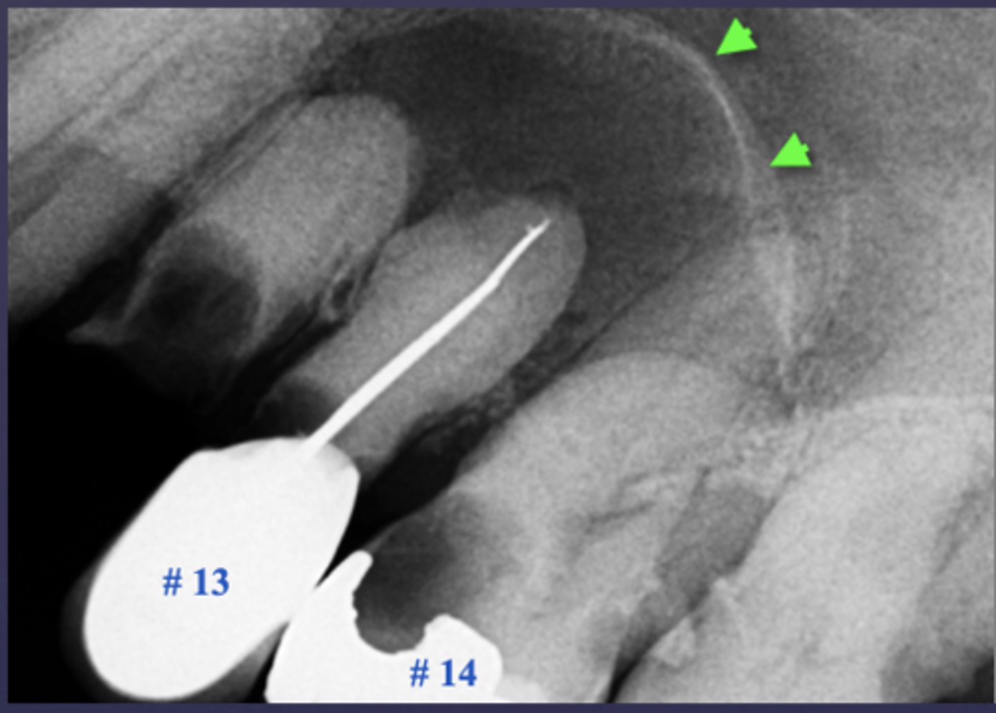 <p>What is the differential diagnosis?</p><p>A) Rarefying osteitis</p><p>B) Maxillary sinus pneumatization</p><p>C) Mucus retention pseudocyst</p><p>D) Sclerosing osteitis</p>