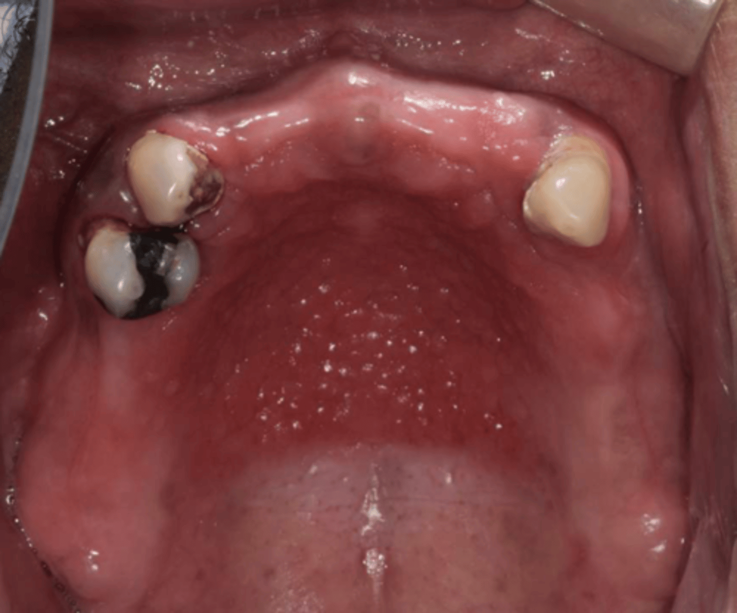 <p>Patient has an RPD. What do you suspect?</p>