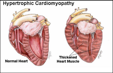 <p>(HCM) Feline Hypertrophic Cardiomyopathy</p>
