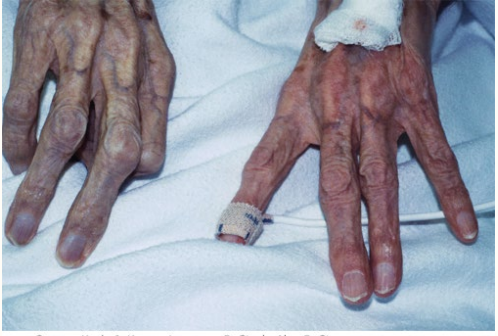 <p><strong>Arterial Embolism/Thrombosis Clinical Manifestations:</strong></p><p>Symptoms</p><p>-____ onset of extremity pain</p><p>-Skin color changes</p><p>-Neurovascular changes</p><ul><li><p>___________</p><p></p></li></ul><p>Physical Exam</p><p>-Decreased/absent ________</p><p>-Decreased __________ refill</p><p>-Coolness of the extremity </p><p>-Skin mottling</p><p>-Decreased sensation</p><p>-_________ in severe cases</p><p></p>