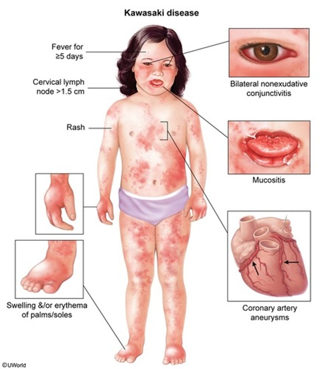 <p>Fever (> 102F) for > 5 days PLUS 4/5 criteria:</p><p>- b/l, painless, nonexudative conjunctivitis</p><p>- oropharyngeal changes (red cracked swollen lips, strawberry tongue)</p><p>- unilateral cervical LAD > 1.5 cm</p><p>- rash</p><p>- extremity changes (hand/foot erythema, swelling, etc.)</p>
