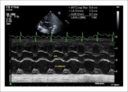 <p>the following m-mode tracing:</p>