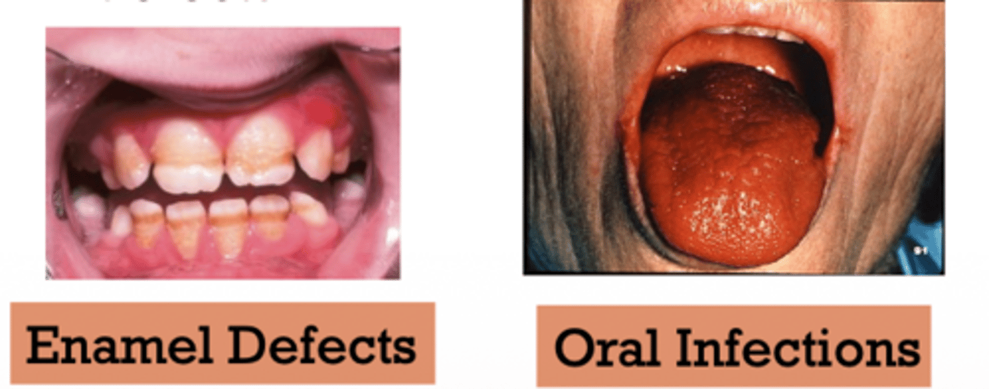 <p>Would the following be caused by overnutrition or undernutrition?</p><p>- Decreased resistance to oral infections</p><p>- Decrease immune response</p><p>- Ultimately may result in increased tooth loss and enamel defects</p>