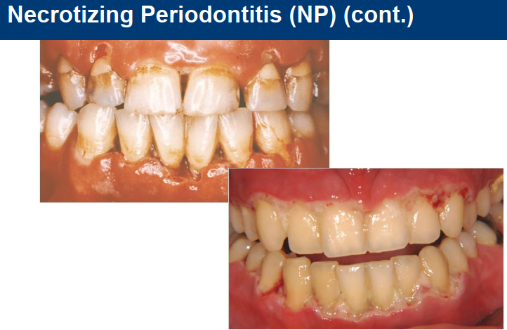 <ul><li><p>Similar to NG but more complex due to extensive tissue destruction</p></li><li><p>Referral to Periodontist </p></li><li><p>Collaboration with pt GP warranted</p></li></ul><p></p>