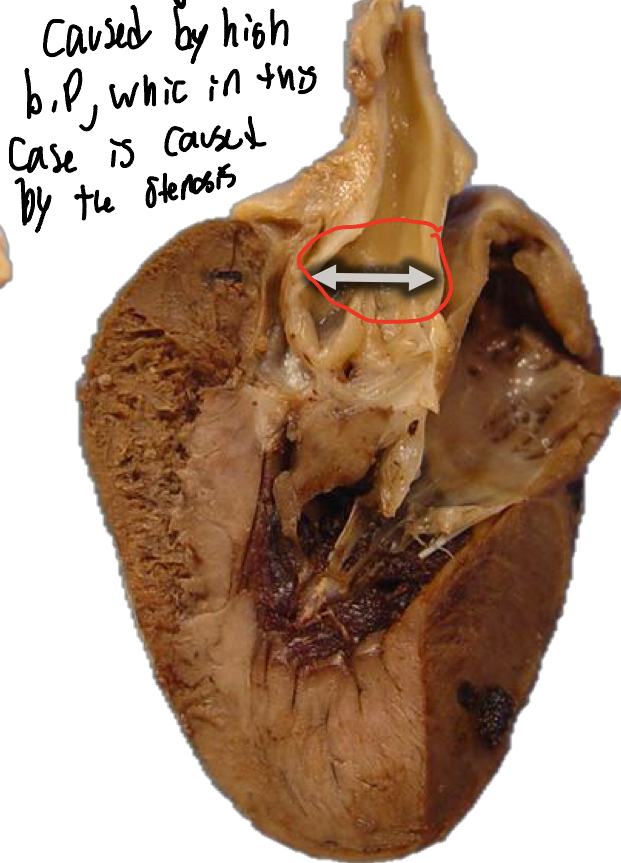 <p>False, it is a Post-stenotic dilation that is often found distal to the stenosis</p>