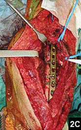 <p><span style="font-family: Lato Extended, Lato, Helvetica Neue, Helvetica, Arial, sans-serif">This picture shows Open reduction external fixation (O.R.I.F)</span></p>