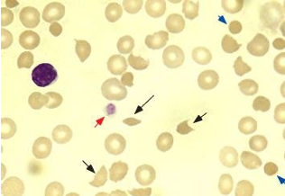 <p>-due to circulating STX (usually STX-2, binds to glomerular epithelial cells): hemolytic anemia with fragmented erythrocytes, acute renal injury, thrombocytopenia, CNS symptoms, HTN</p><p>-can cause capillary thrombosis and inflammation/damage colonic mucosa → hemorrhagic diarrhea</p>