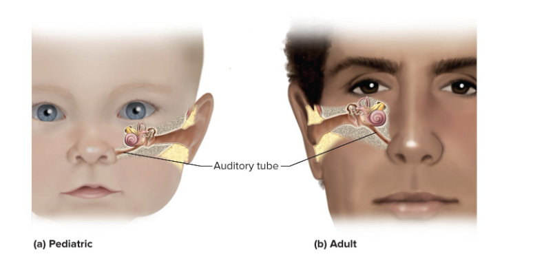 <p>Middle-ear infection </p><ul><li><p>is common in children</p></li><li><p>Auditory tube is short and horizontal</p><ul><li><p>infections easily spread from throat to tympanic cavity and mastoid air cells</p></li></ul></li><li><p>Symptoms</p><ul><li><p>Fluid accumulates in tympanic cavity producing pressure, pain, and impaired hearing</p></li><li><p>Can spread, leading to meningitis</p></li><li><p>Can cause fusion of ear ossicles and hearing loss</p></li><li><p>makes patient have a hard time hearing bc fluid build up doesn't allow eardrum to work properly</p></li></ul></li></ul><p></p>
