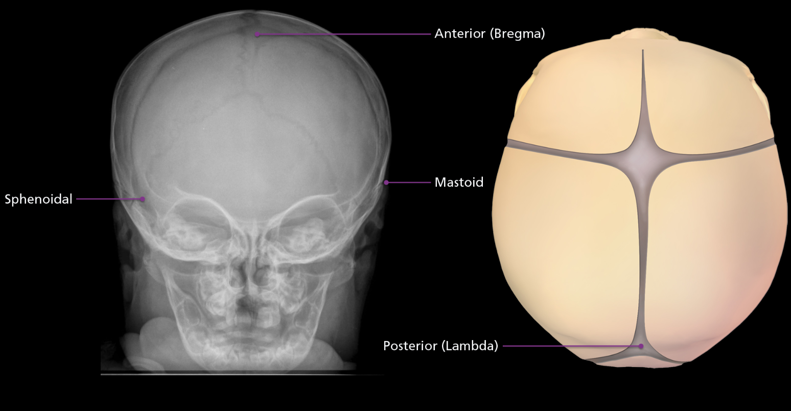 <p>A total of 6 “soft spots” that allow the cranium to flex and mold during birth and accommodate brain growth.  The two largest are the anterior fontanelle called the bregma, located at the junction of the patal and frontal bones. The posterior fontanelle is known as the lambda, located at the junction of the parietal and occipital bones. Anterior fontanelle closes around 2 years old, posterior within first few years of life. On the side of the skull are 2 sphenoidal fontanelles found at the junction of the frontal, sphenoid, parietal, and temporal bones. The mastoid fontanelles are location at the intersection of the occipital, parietal, and temporal bones.</p>