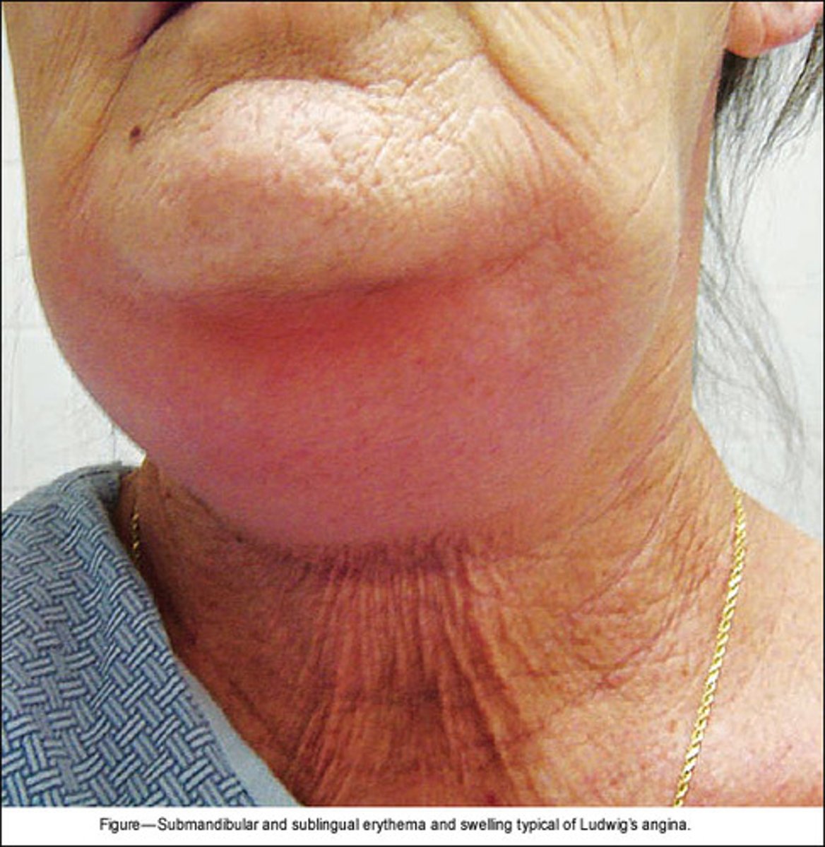 <p>recent dental pain, mouth pain, fever, fatigue, chills, weakness, trismus</p><p>tripod position, drooling, dysphagia, "hot potato voice", tongue swelling, bull neck, firm &amp; swollen floor of mouth, restricted tongue mobility, restricted mouth opening</p>