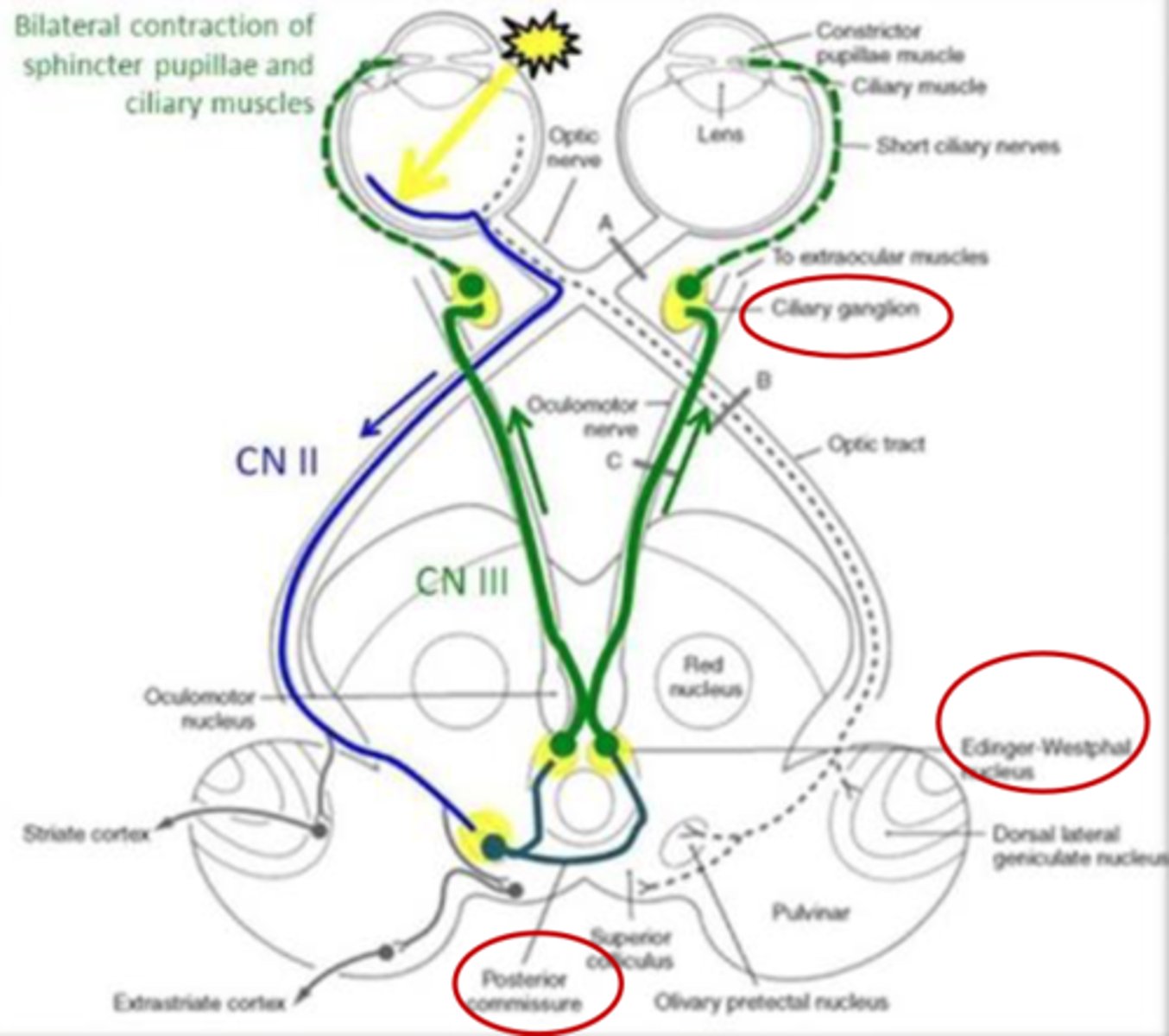 <p>- Pupillary light reflex dysfunction</p><p>- No reflex in left eye</p><p>- Reflex in right eye</p>