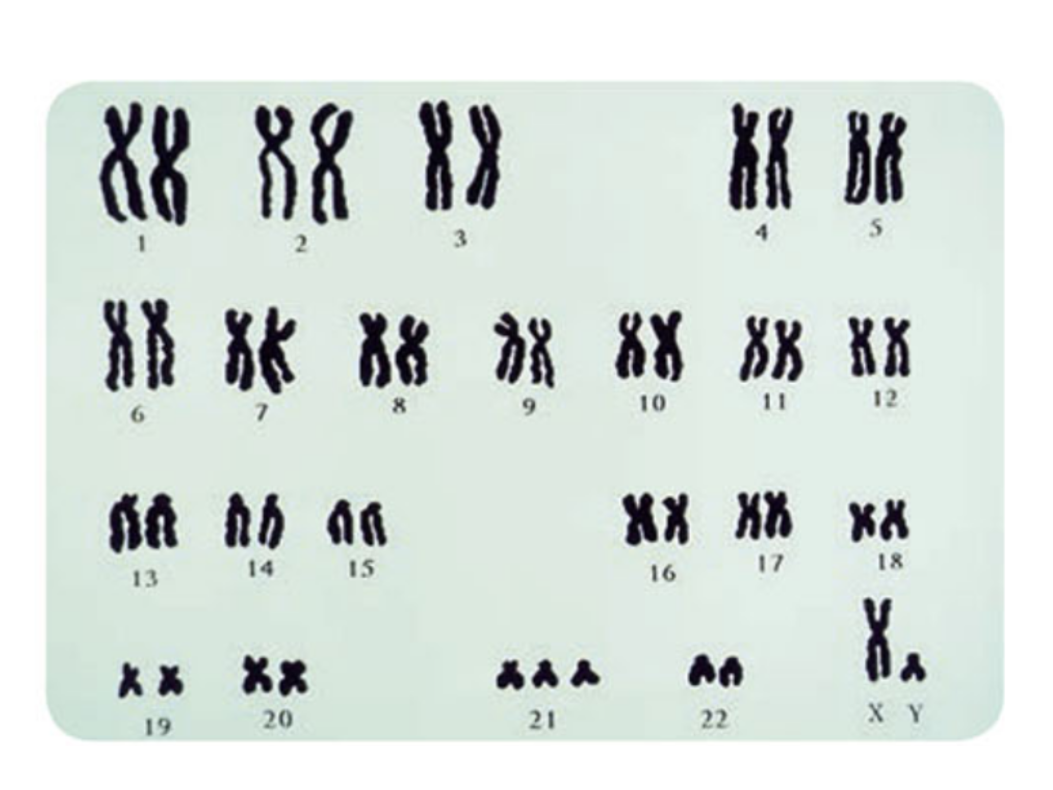 <ol><li><p>State the total number of chromosomes shown.</p></li><li><p>State if child is male or female and justify answer</p></li><li><p>As the geneticist, advice the parents in the health of the baby</p></li></ol>