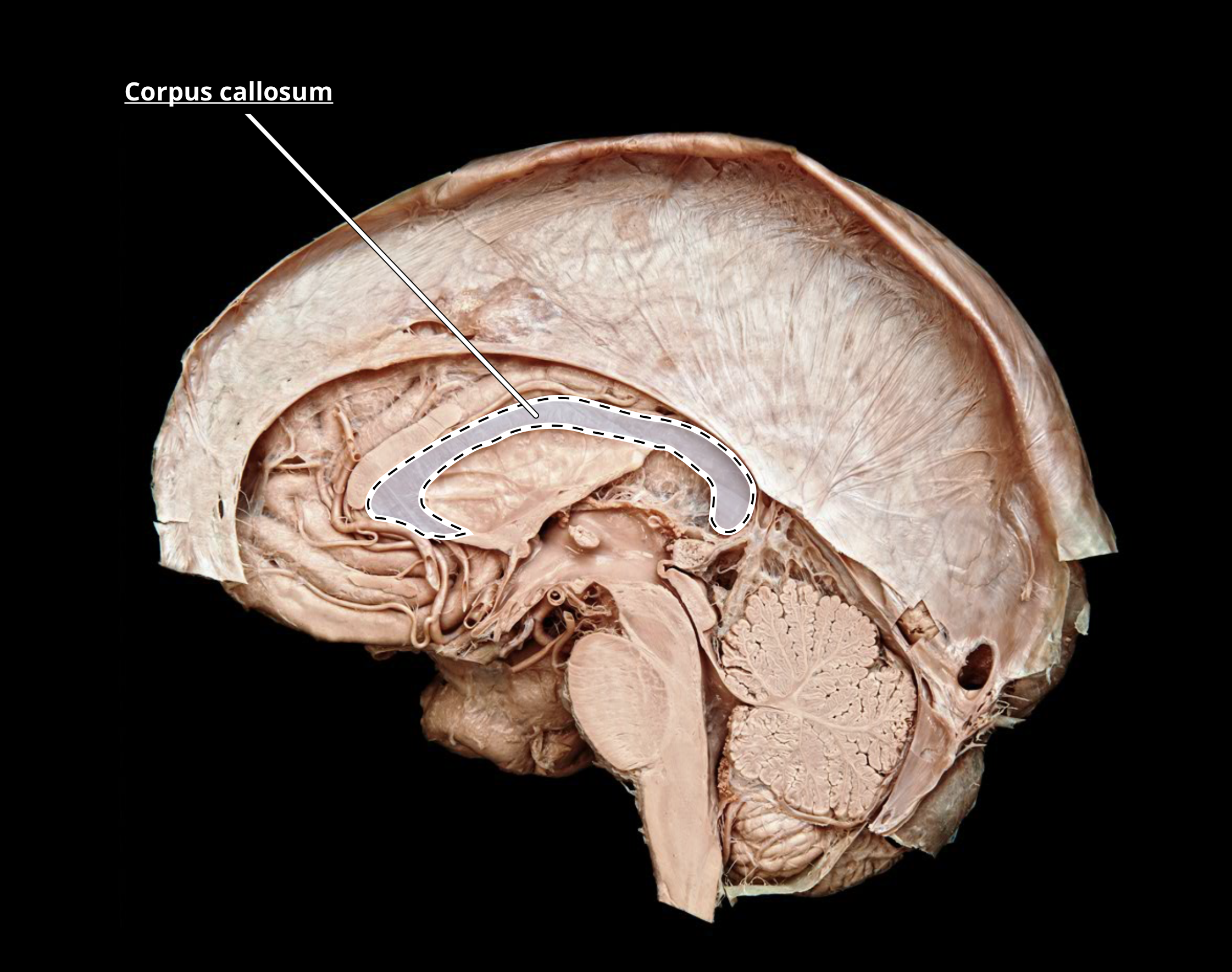<p>corpus callosum</p>