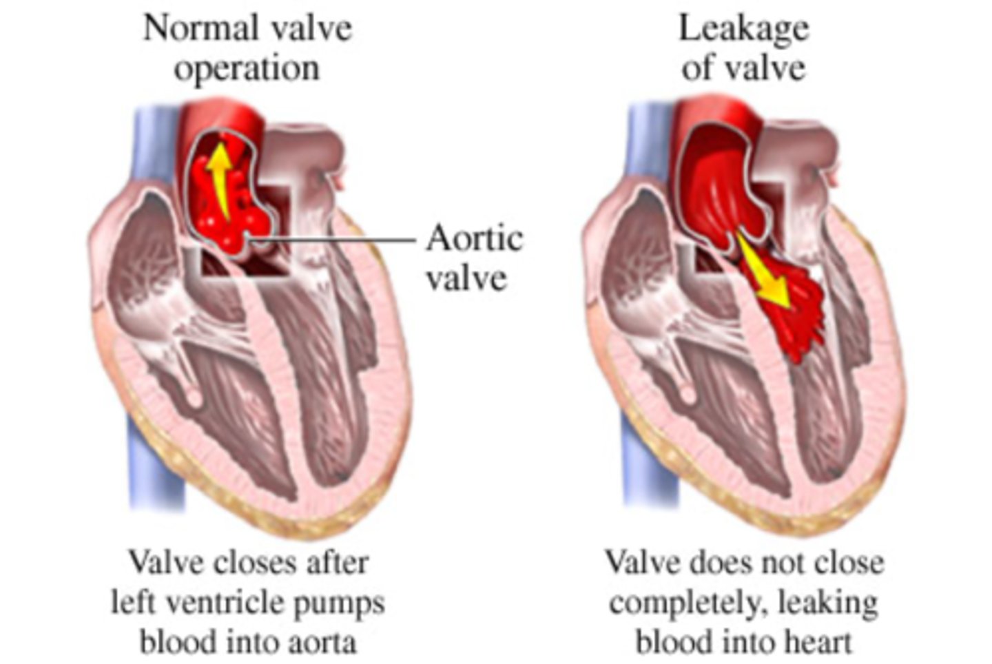 <p>inability of the aortic valve leaflets to close properly during diastole</p>