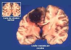 <p>destruction of brain tissue. May occur naturally or experimentally</p>
