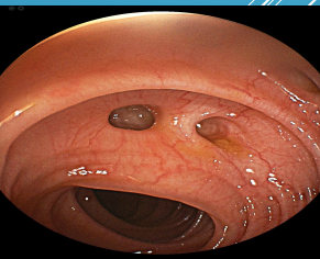<p><strong>Diverticular Disease </strong></p><p>-Diverticula → ____________ of colonic wall </p><p>-__________→ presence of diverticula and typically asymptomatic </p><p>-Diverticulitis → inflammation and/or __________ diverticular disease </p><p>-Risk Factors → _____ age, obesity, smoking, ____ (low fiber, high fat, red meat), physical inactivity, and medication use (ASA, _______, steroids, opiates) </p>