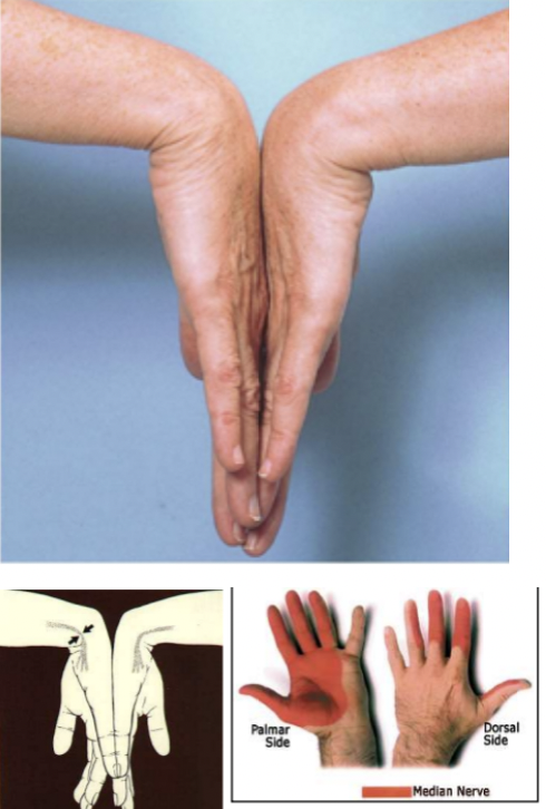 <p><span style="font-family: Calibri, sans-serif">Carpal Tunnel Syndrome&nbsp;</span></p><ul><li><p><span style="font-family: Calibri, sans-serif">tingling/pain in median nerve distribution</span></p></li><li><p><span style="font-family: Calibri, sans-serif">A positive test is tingling and/or pain in the median nerve distribution</span></p></li></ul><p></p>