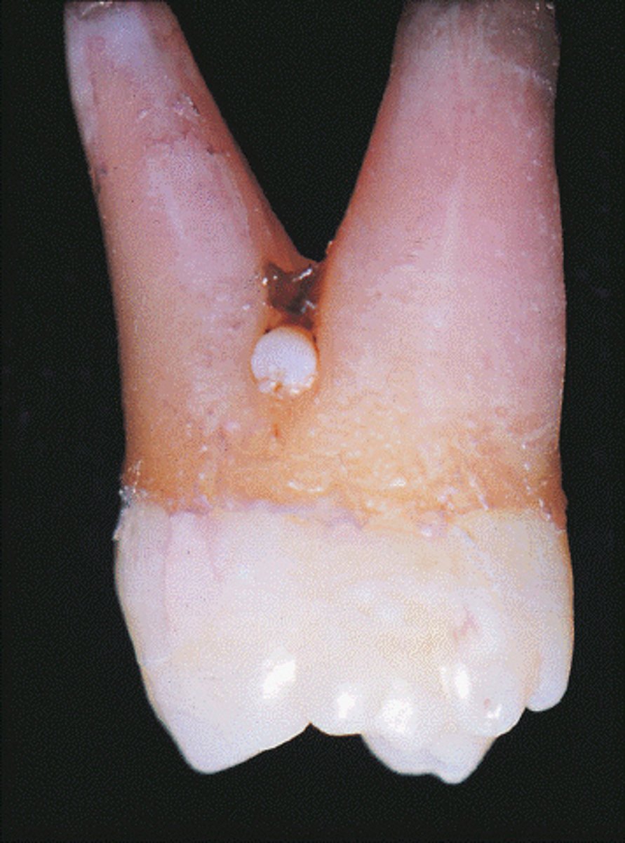 <p>Enamel pearl</p><p>The enamel pearl is a projection of enamel caused by abnormal displacement of ameloblasts during tooth formation. It is found near the furcation in maxillary molars. Dens evaginatus is an accessory enamel cusp found on the occlusal surfaces of mandibular premolars. A supernumerary cusp would be on or near the occlusal surface. Calculus is not a developmental anomaly.</p>