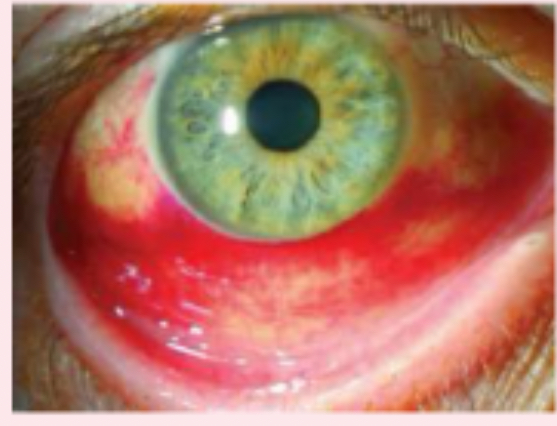 <p>bright red areas of the sclera </p>