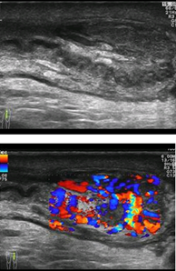 <p>epididymitis</p>