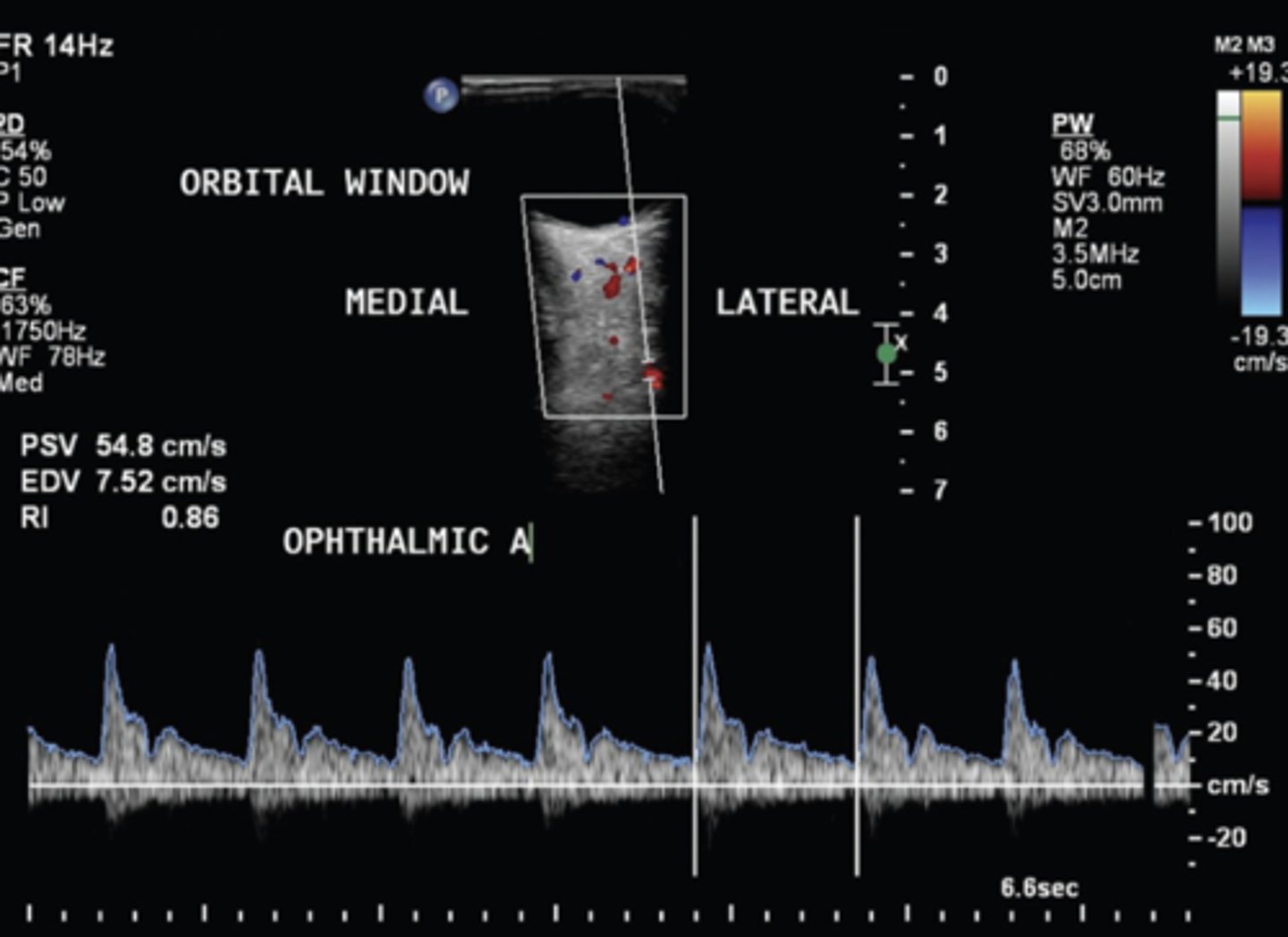 <p>Orbital window</p><p>35 - 55 mm depth</p><p>Flow towards tx (red)</p><p>21 +/- 5 cm/sec</p>