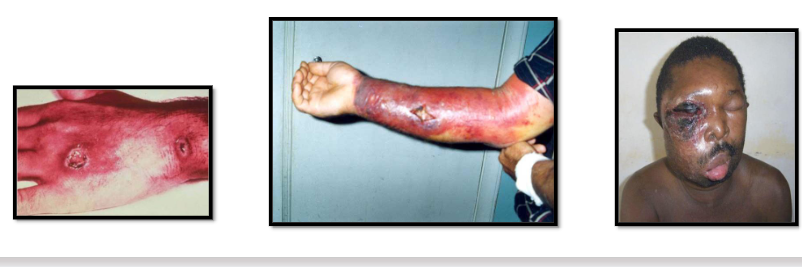 <ul><li><p><span><span>Кожна – най-често срещана, засяга кожата на лицето, ръцете и шията.<br>Поява на везикула със серозно съдържимо, по-късно - пустула с<br>кървенисто виолетов цвят. След пукането й се формират язви,<br>обградени от силно изразена отточна зона.В някои случаи може да засегне очите и устата – протича тежко; 5-20% леталитет</span></span></p></li><li><p><span><span>Белодробна форма – протича като тежка пневмония; 100% леталитет</span></span></p></li><li><p><span><span>Чревна форма – протича като тежък ентерит с кървесто-слузеста<br>диария;</span></span><span>100% леталитет</span></p></li><li><p><span><span>Септична форма-</span></span><span>100% леталитет</span></p></li></ul><p></p>