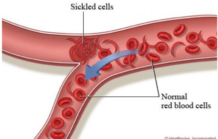 <p>most common inherited blood disorder in the USA, non-synonymous point mutations in hemogloin beta gene</p>