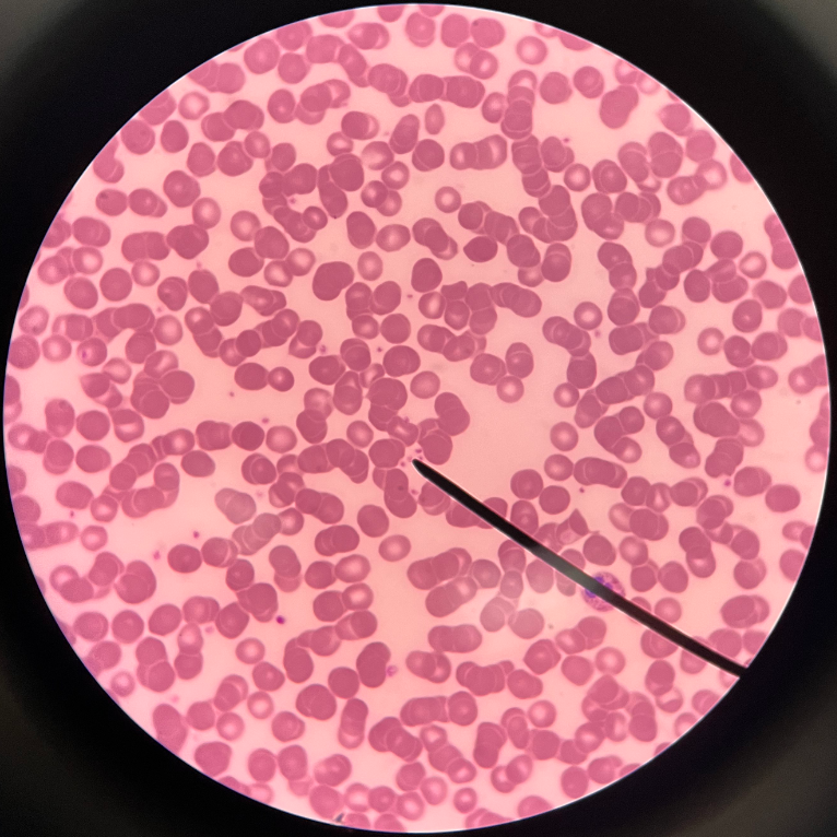 • Cytoplasmic fragments of megakaryocytes.

• Appears small and irregularly shaped.

• Controls hemostasis (blood clotting).

• Also known as a thrombocyte.