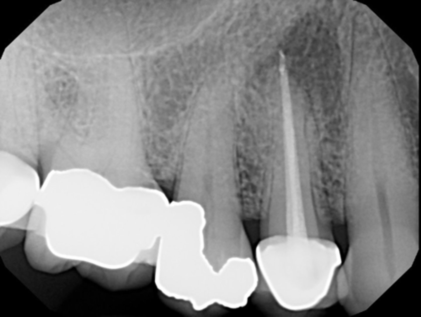 <p>Define the following:</p><p>- Pain not due to overextended material but due to inadequate apical seal</p><p>- Tugback and searing GP 5-7mm from apex to allow GP to fill in 3-D</p><p>- Fenestration</p>