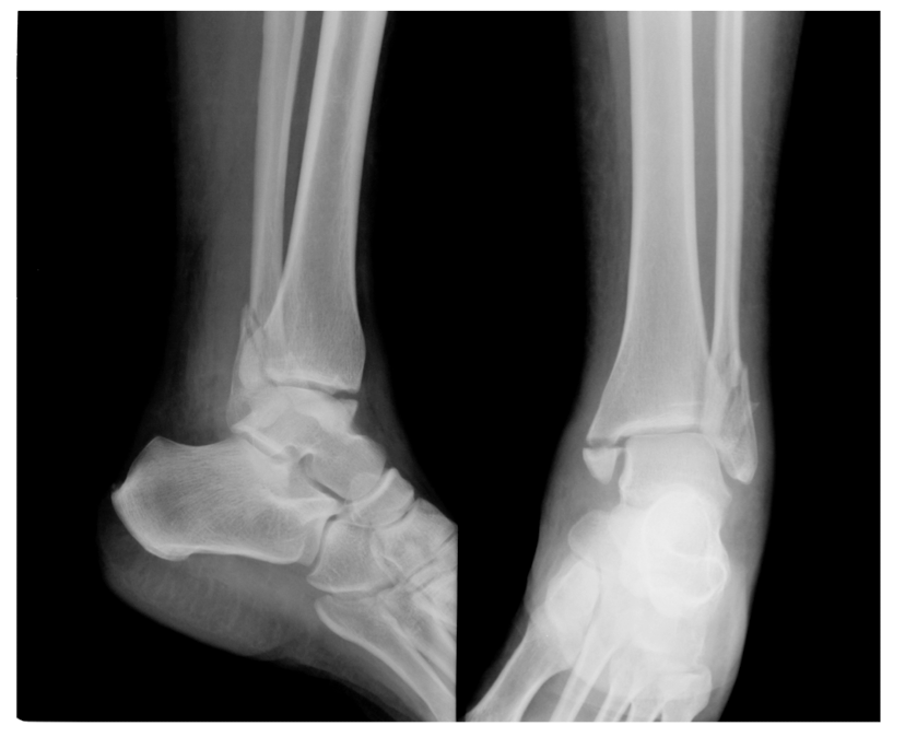 <p>What type of Ankle Malleolar fx is this?</p>