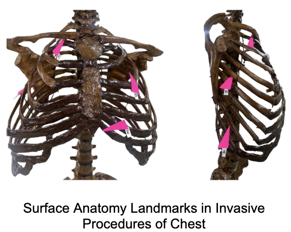 <p>Where is: <span>9th ICS, Right, Anterior Axillary Line&nbsp;</span></p>