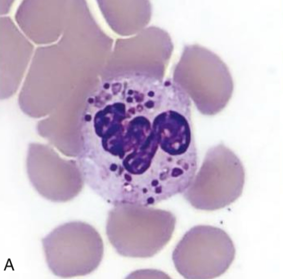 <p>Identify the cell and abnormality</p>