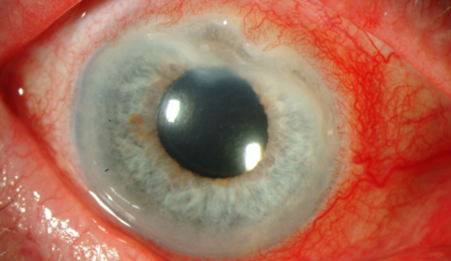 <p>a rare inflammatory disorder of the peripheral cornea occurring due to underlying disease (RA, infection, post-surgery, dermatological disease, etc.). Exact mechanism is unknown. Is unilateral almost always. Appears as a crescent shaped peripheral corneal ulceration with overlying stromal infiltration. Presents as redness, pain (+++), tearing, and photophobia. VA may be degraded due to induced astigmatism. Treatment involves addressing the underlying cause.</p>