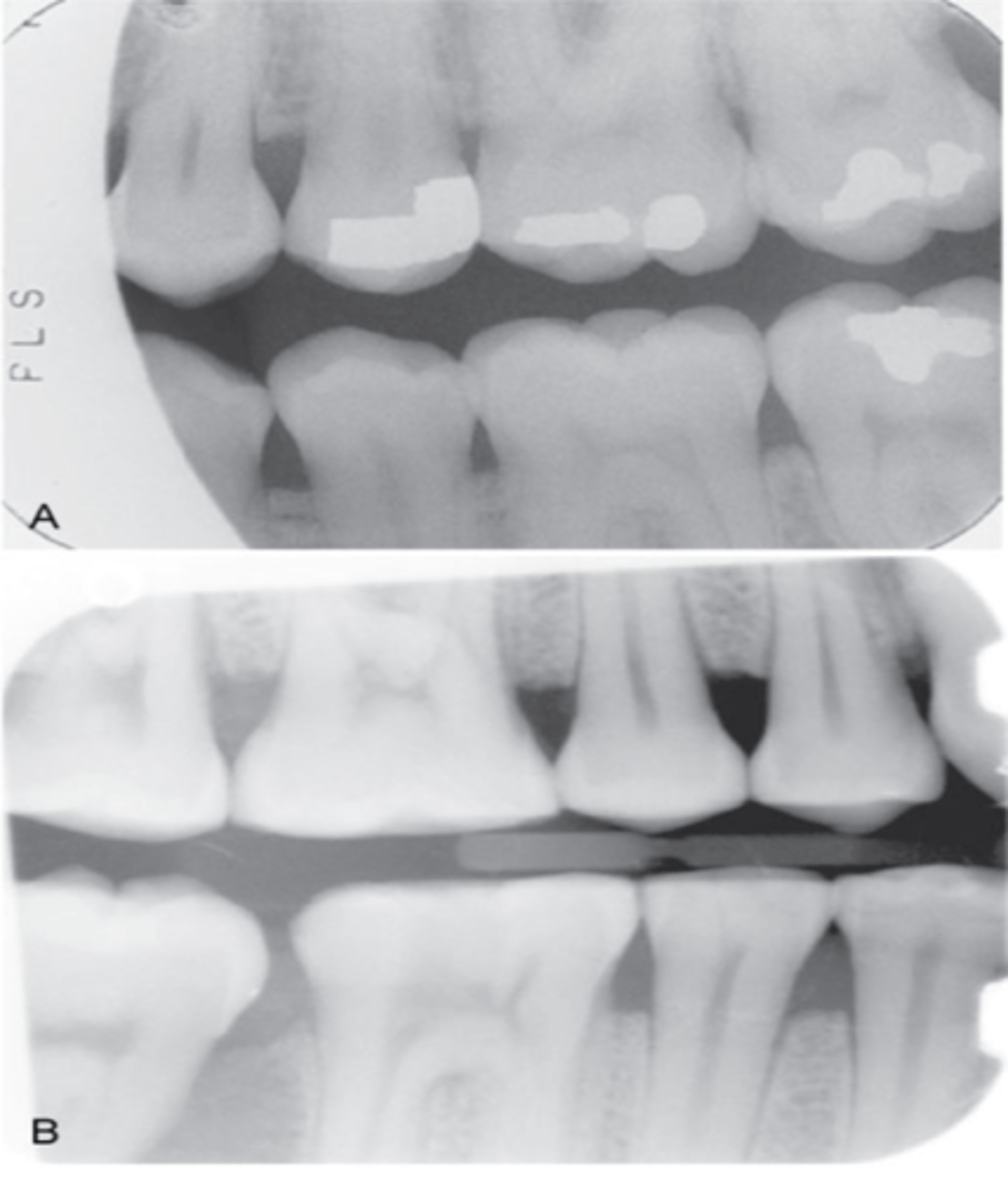 <p>clear or white rounded unexposed area</p><p>PID was not properly aligned with the beam alignment device</p>
