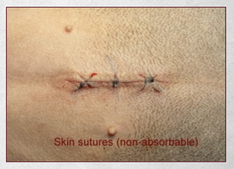 <p>-immediate closure of wound</p><p class="p1">-clean wounds</p><p class="p1">-clean-contaminated wounds</p>