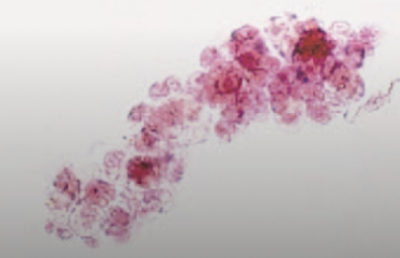 <ol start="56">
<li>Characteristics of epithelial casts</li>
</ol>